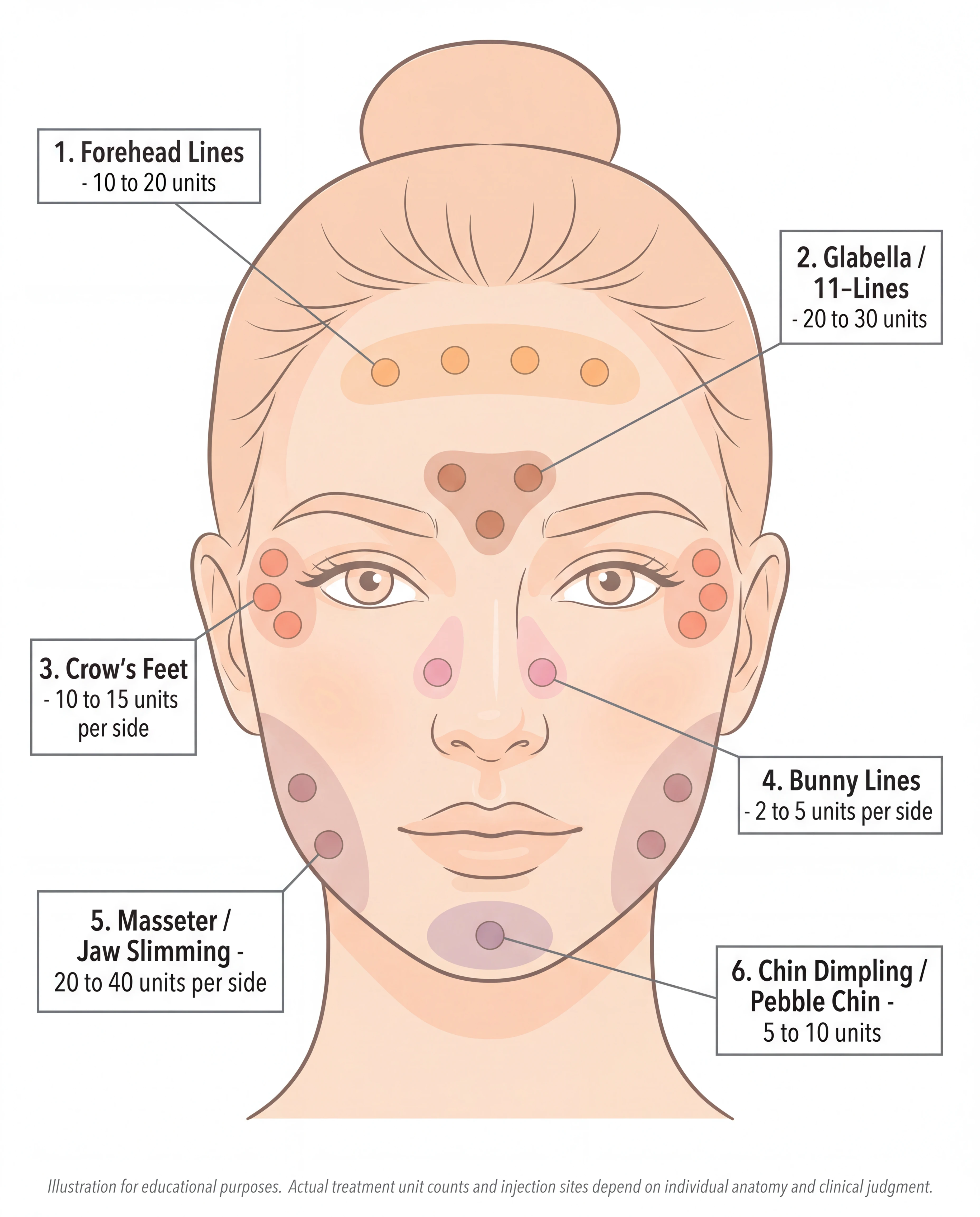 Botox facial injection point map showing a frontal view of a synthetic woman with 6 color-coded treatment zones labeled with unit ranges: zone 1 forehead lines 10 to 20 units in orange across upper forehead, zone 2 glabella 11-lines 20 to 30 units in terracotta between the brows, zone 3 crows feet 10 to 15 units per side in soft coral at outer eye corners, zone 4 bunny lines 2 to 5 units per side in soft pink at the nose bridge, zone 5 masseter jaw slimming 20 to 40 units per side in dusty rose along the jawline, zone 6 chin dimpling pebble chin 5 to 10 units in mauve centered on the chin, AI-generated educational illustration not based on any real person